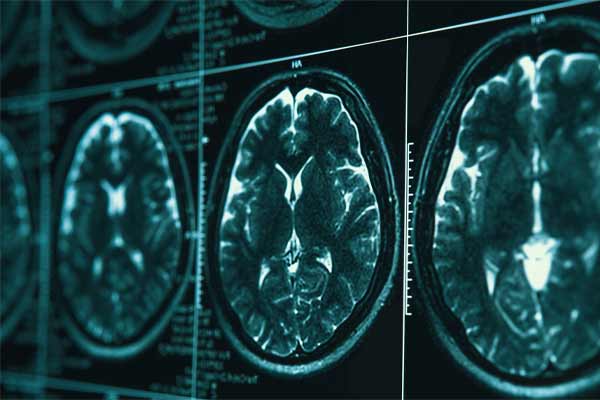 estudio que muestra daño de cerebral a causa de un accidente en chicago